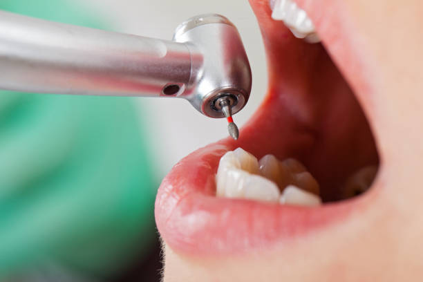 Best Emergency Dental Extractions in Scottsburg, IN